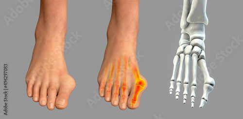 Toe deformation, also known as hallux valgus, or bunion photo