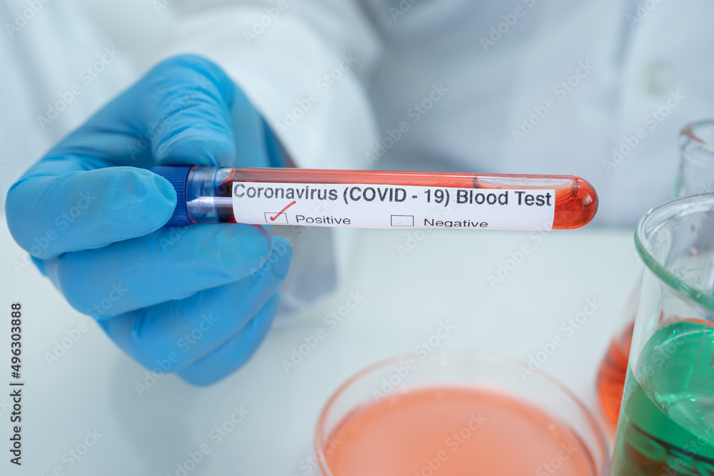 Positive blood infection sample in test tube for covid-19 coronavirus in lab. Scientist holding to check and analyze for patient in hospital. Positive blood infection sample in test tube for covid-19 coronavirus in lab. Scientist holding to check and analyze for patient in hospital.