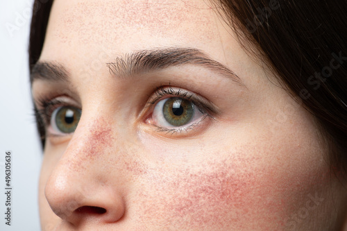 Face of girl with red cheeks from rosacea photo