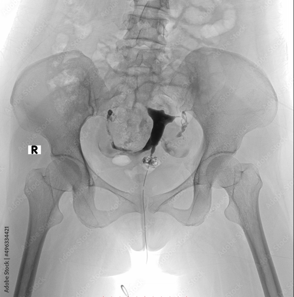 Hsg Image Normal Inverted x ray image of Normal Hysterosalpingography (HSG) Stock Photo | Adobe Stock