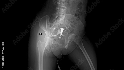 x ray image of Normal Hysterosalpingography (HSG)