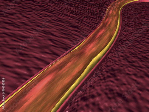 Close-up of the human artery showing fat deposited on the inner walls