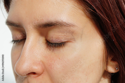 Young woman with spider veins and broken capillaries around eyes.