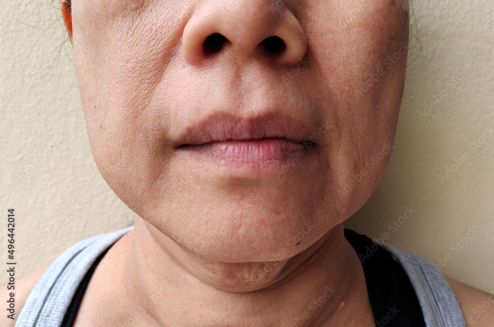 Fototapeta premium Portrait showing the flabbiness adipose hanging on the face, problem wrinkled and cellulite under the eyes of the woman, concept health care.