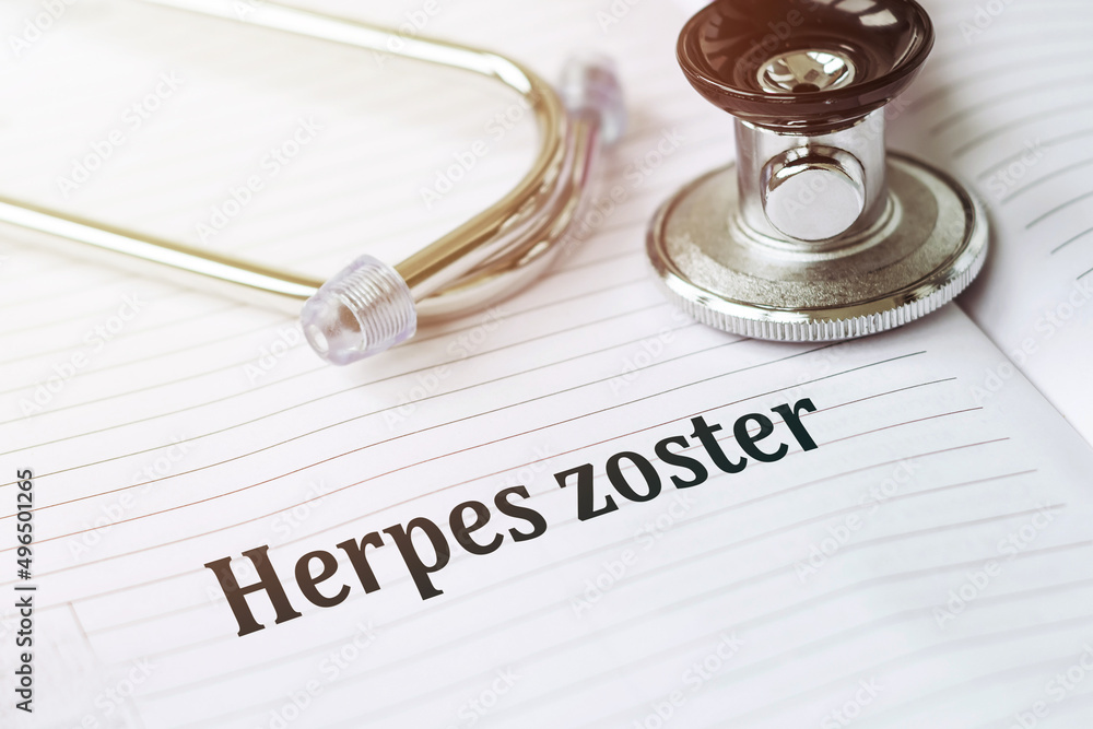 Text HERPES ZOSTER in a medical card next to a stethoscope. Text HERPES ZOSTER in a medical card next to a stethoscope.