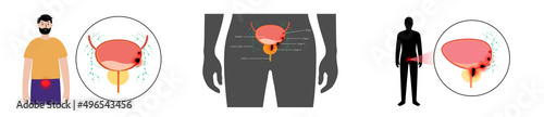 Bladder cancer stages