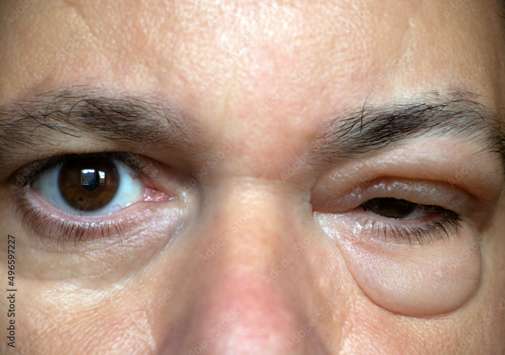 The Inflammation of the eyelid. Swelling of the eye after insect bite