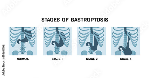 Stages of gastroptosis. Dropped stomach. Shapes and positions of the stomach