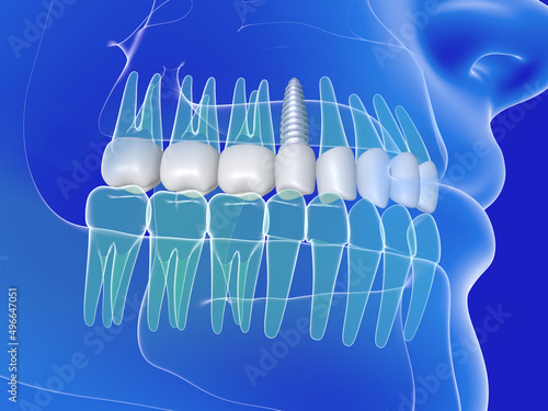 3d illustration of a dental implant. Anatomical image of the teeth and mouth, transparent on a blue background. photo