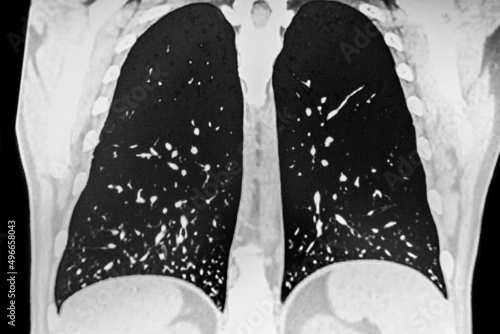Fotografía Chest CT- Scan showing multiple small lesions compatible with pulmonary histopla