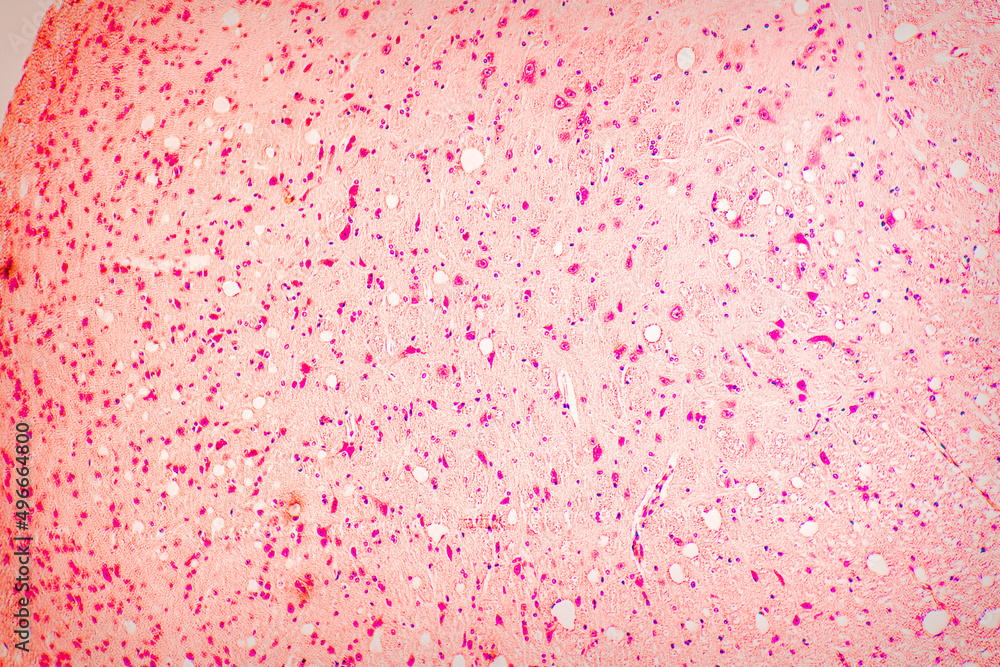 tissue slice biopsy to check for a malignant tumor. View in a microscope tissue slice biopsy to check for a malignant tumor. View in a microscope