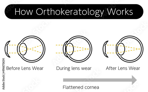 視力矯正レンズ、オルソケラトロジーレンズの仕組み（英訳）