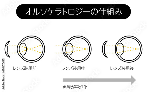視力矯正レンズ、オルソケラトロジーレンズの仕組み