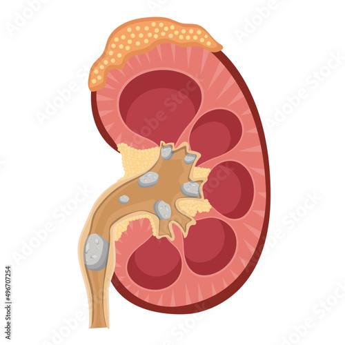 kidney stones flat vector illustration