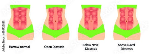Diastasis illustration. Different types of diastasis. Abdomen wall muscle separation 