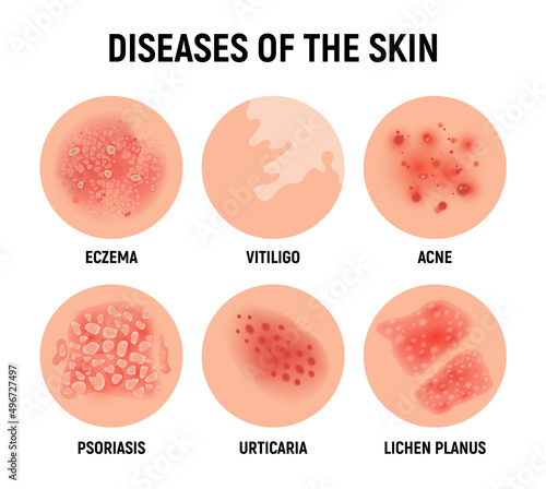 Psoriasis rash vector skin hand infection background. Psoriasis dermatitis eczema cartoon illustration