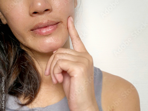 Woman with chapped and dry lips background. Health care concept. photo