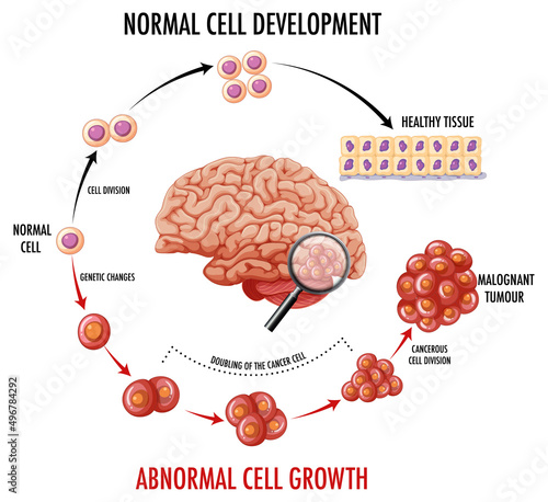 Diagram showing human brain and cancer