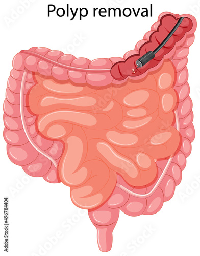 Diagram showing polyp removal