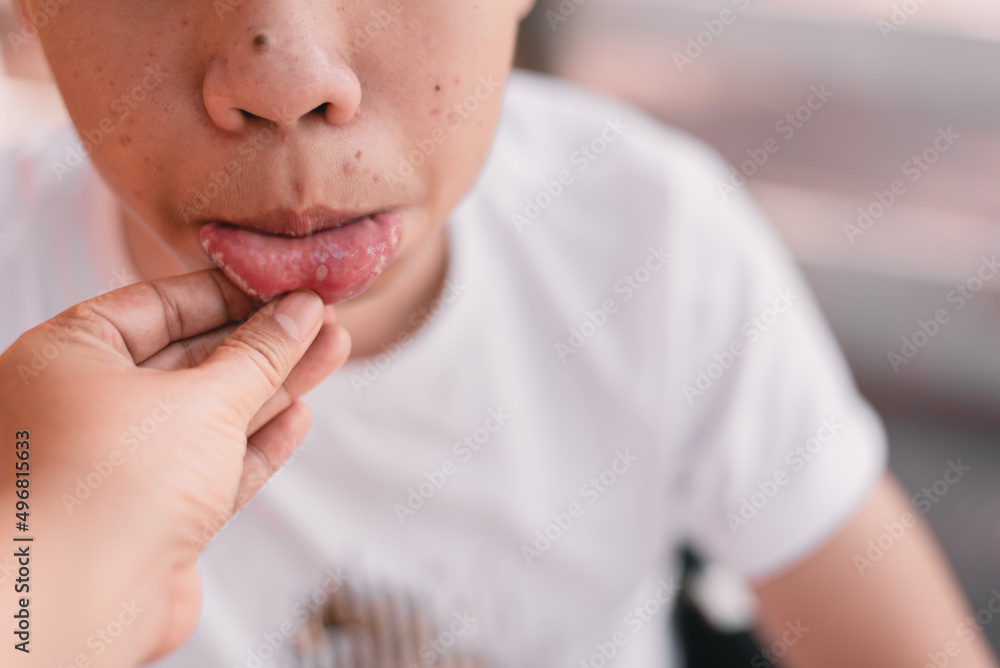 Hand of parent or doctor checking for mouth ulcers of a young Asian man