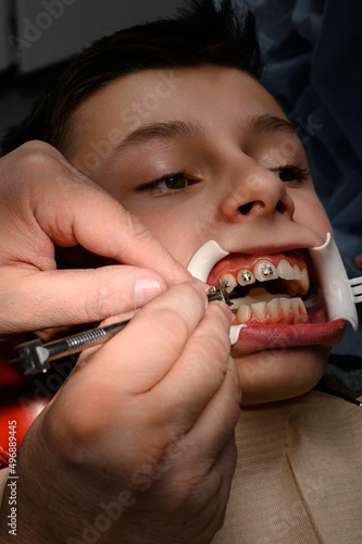 Close up of installing braces on teeth  aligning teeth with braces  retractor on lips.