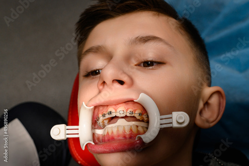 Visit to the orthodontist, installation of braces on the upper teeth, white retractor on the lips of the child. photo