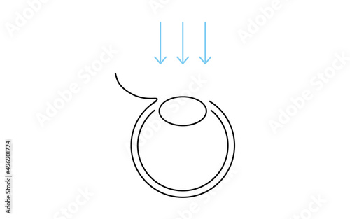 レーシック、屈折矯正手術のメディカルイラスト