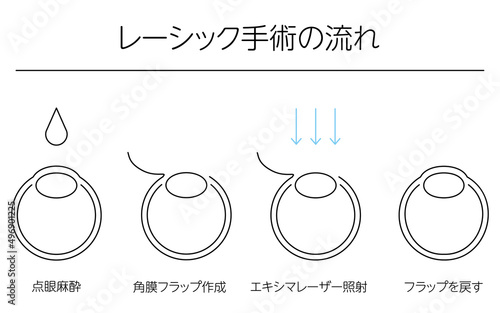 レーシック、屈折矯正手術のメディカルイラスト