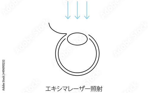 レーシック、屈折矯正手術のメディカルイラスト