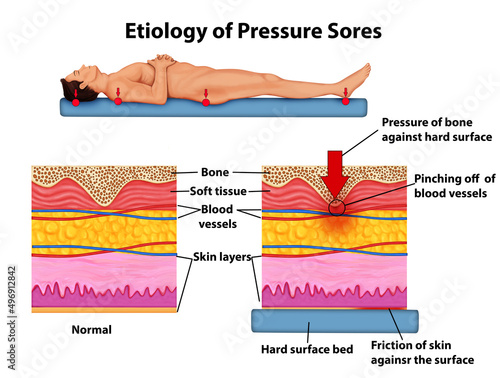 Fotografie Etiology of pressure sores