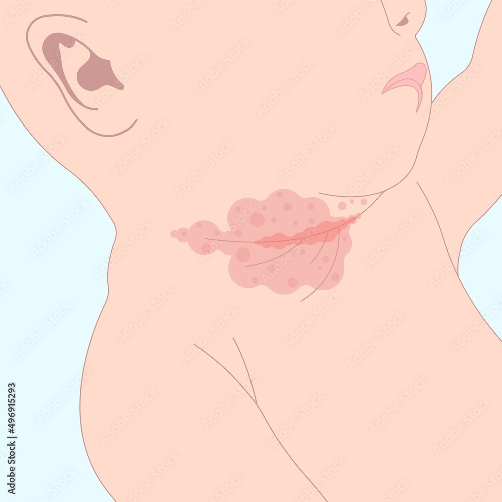 bacterial prevent skin rash allergy hives food cloth staph heat red thrush burn cream bottom infant newborn child kids wet wear clean thigh treat itchy pain baby oils care home chafe sore leg bleed