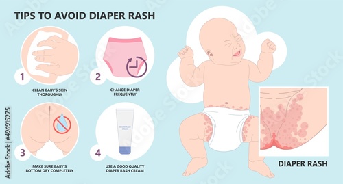 infant newborn child kids skin rash allergy hives food cloth staph heat red thrush burn cream bacterial bottom wet wear clean thigh treat prevent itchy pain baby oils care home chafe sore leg bleed photo