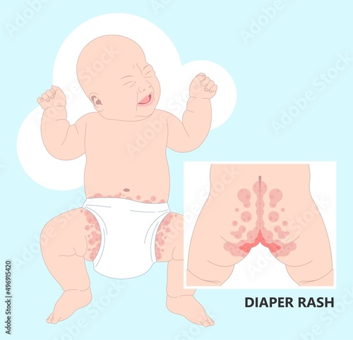 baby Skin itchy rash allergy hives food cloth staph heat red thrush burn cream bacterial bottom infant newborn child kids wet wear clean thigh treat prevent pain oils care home chafe sore leg bleed