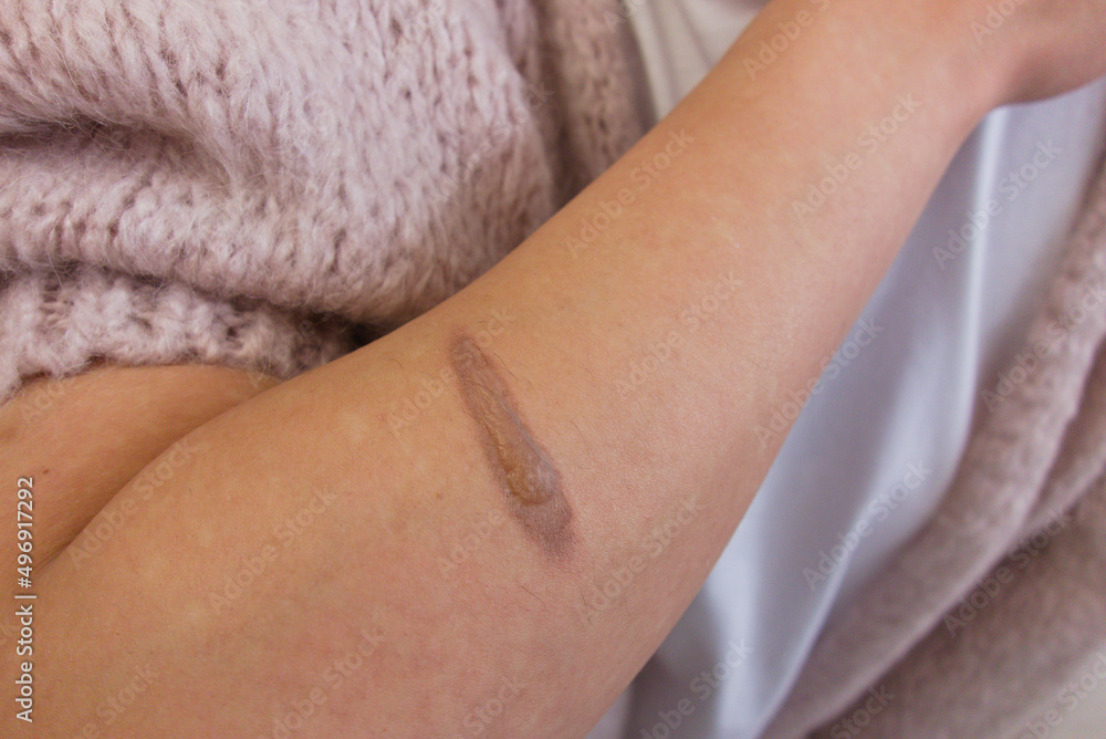 Female hand with thermal burn of the skin. Domestic injury during ironing or cooking Female hand with thermal burn of the skin. Domestic injury during ironing or cooking
