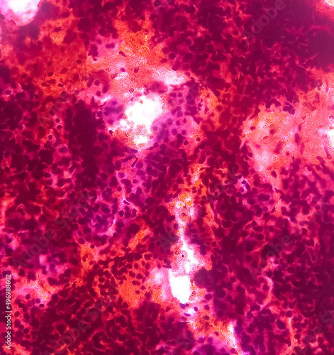 Fine needle aspiration (FNA) cytology of chronic sialadenitis of neck, show cellular material composed of salivary acini, lymphocytes and histiocytes on background of blood.