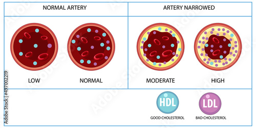 Types of Cholesterol HDL and LDL