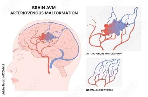 scalp brain ct scan X-ray image mri diagnose Blood AVM artery veins flow stroke Loss of optic nerve pain head galen swelling tangle capillaries system nidus cerebral attack Transient dural fistula