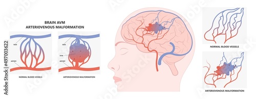 swelling capillaries veins scalp brain ct scan X-ray image mri diagnose Blood AVM artery flow stroke Loss of optic nerve pain head galen tangle system nidus cerebral attack Transient dural fistula