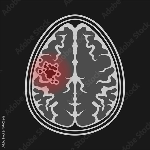 ct scan X-ray image mri diagnose capillaries system stroke scalp brain Blood AVM artery veins flow Loss of optic nerve pain head galen swelling tangle nidus cerebral attack Transient dural fistula