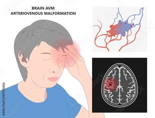 swelling capillaries veins scalp brain ct scan X-ray image mri diagnose Blood AVM artery flow stroke Loss of optic nerve pain head galen tangle system nidus cerebral attack Transient dural fistula