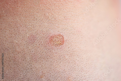 Spot on skin has traces of nevi and birthmar closeup photo