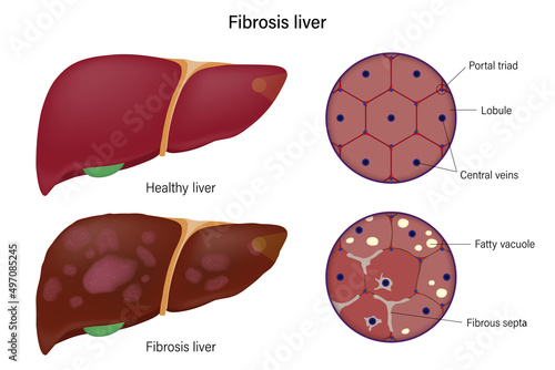 Liver histology. Normal liver and fibrosis liver. Liver disease for medical education and science.