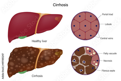 Liver histology. Normal liver and cirrhosis liver. Liver disease for medical education and science. photo