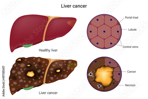 Liver histology. Normal liver and liver cancer. Liver disease for medical education and science.