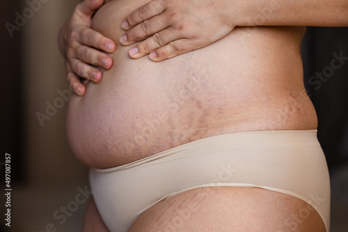 Cropped image fat overweight woman hand on tummy, with stretch marks, striae. Corpulence fat folds hanging, diastasis. Body after childbirth, fibrous collagen, dehydrated. Skin puffiness. Close up