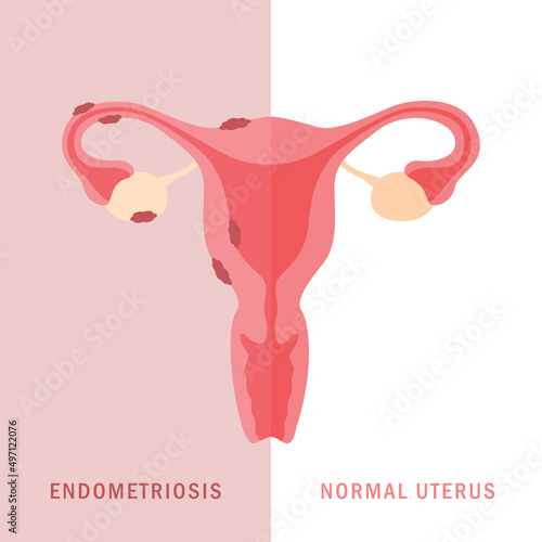 endometriosis and normal uterus womens health anatomy info graphic