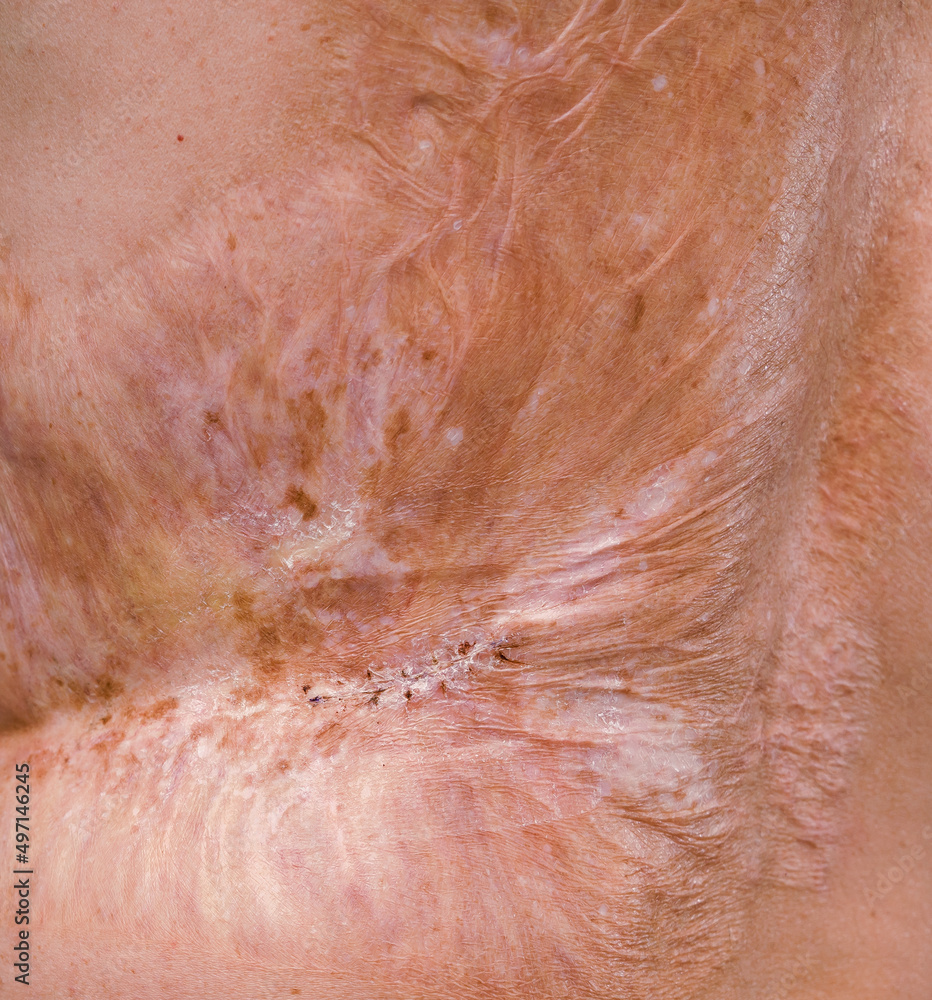 Fototapeta premium Man with a severe burn all over his body. Close up.