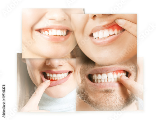 Konstfotografi Collage with people suffering from gum inflammation