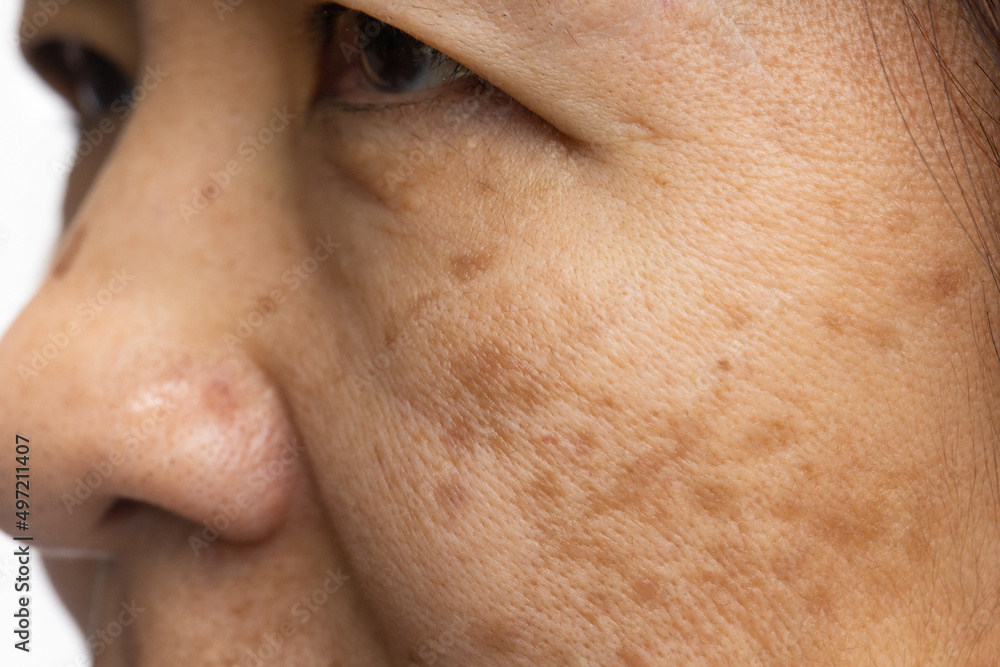 Menopausal women worry about melasma on face. Menopausal women worry about melasma on face.