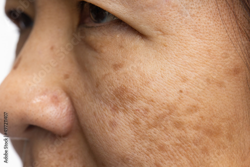 Menopausal women worry about melasma on face. photo
